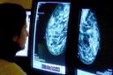 A hospital in Suffolk is set to use artificial intelligence to help cut down the five-year cancer backlog. File photo.